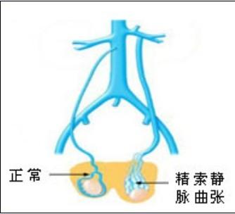 左侧精索静脉曲张病因有哪些