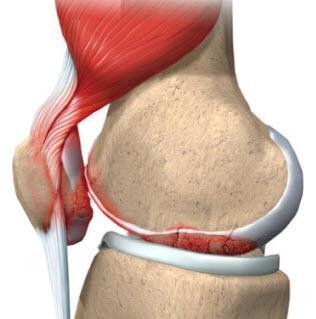 当归拈痛汤治疗湿热痹阻型类风湿关节炎50例